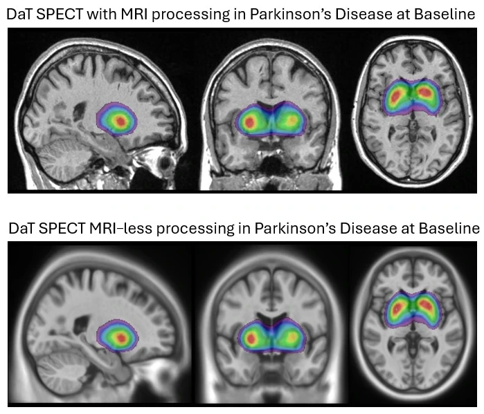 DAT SPECT images example