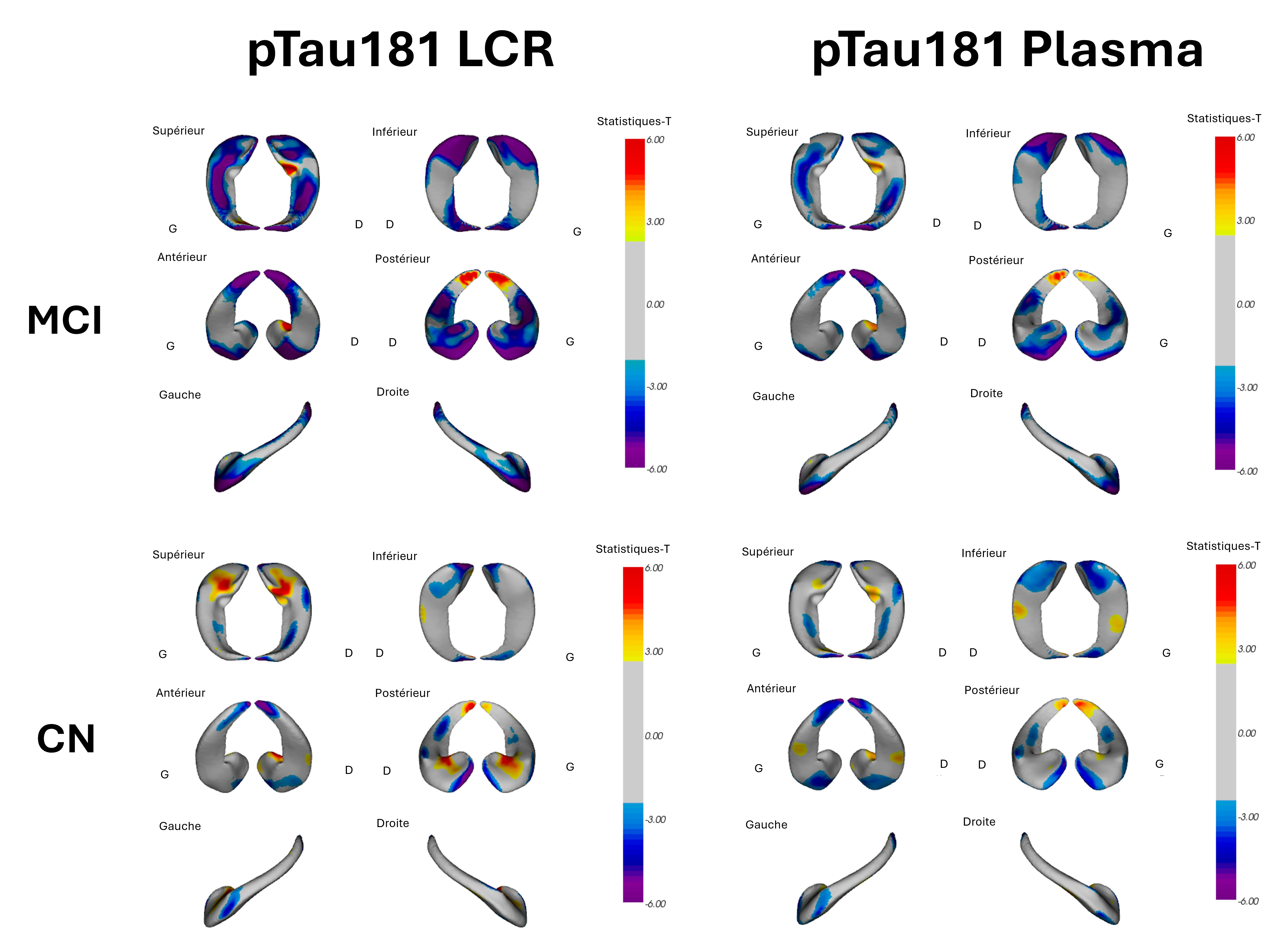 Lien entre la déformation de la surface de l'hippocampe et les taux de ptau181 dans le LCR et le plasma