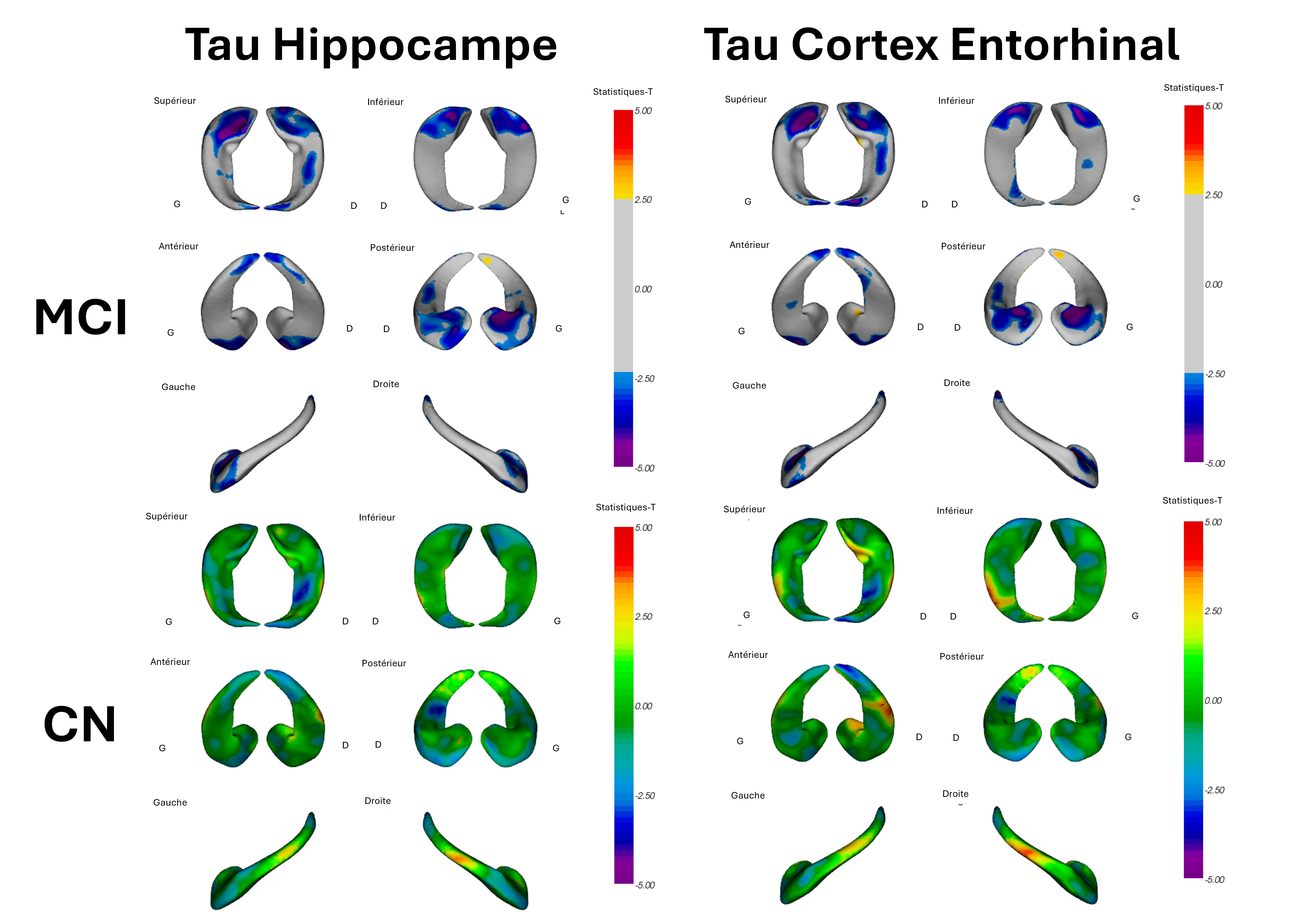 Déformation de l'hippocampe évaluée par le SUVR de la TEP au tau