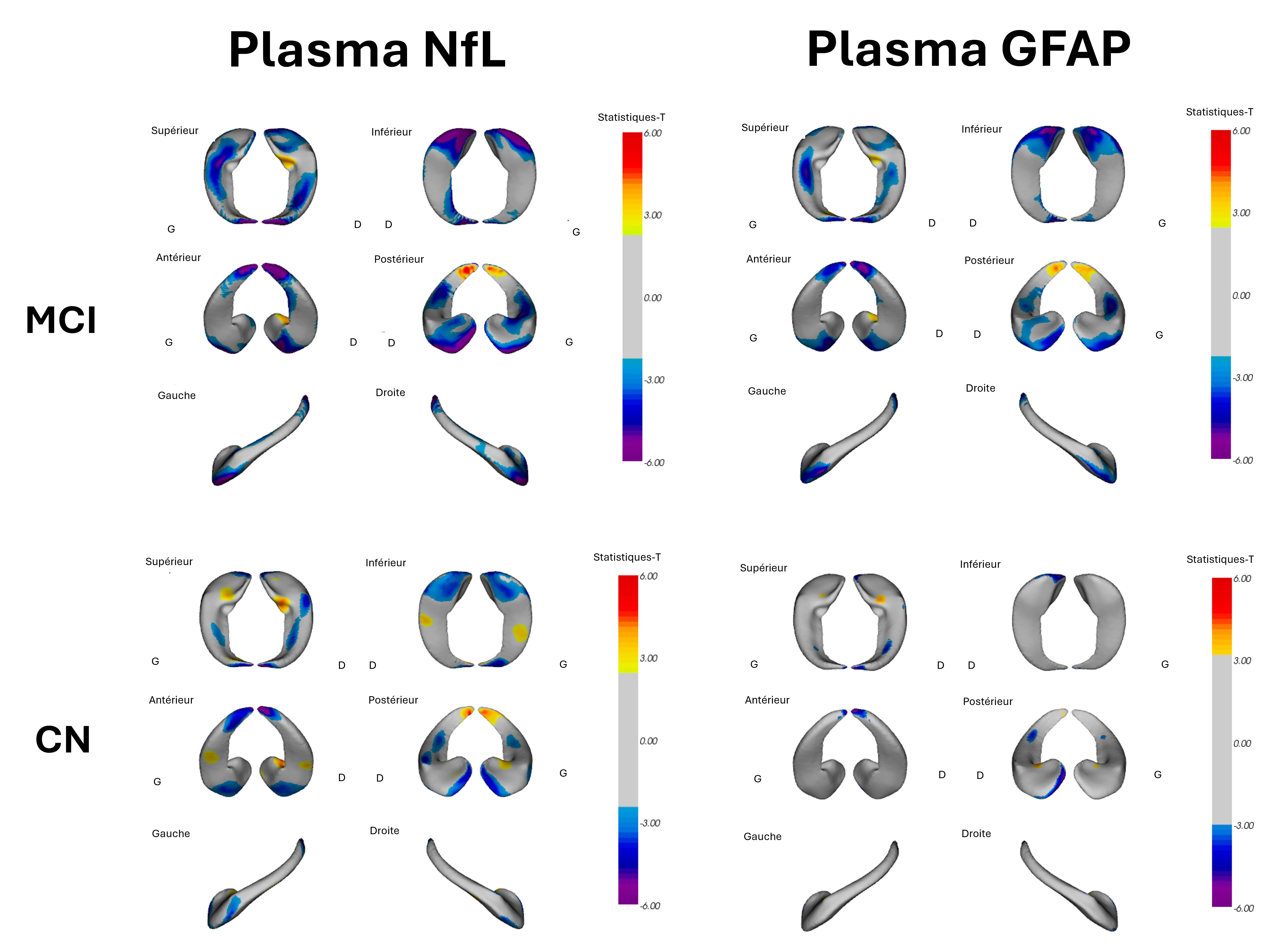 L'association entre la déformation de l'hippocampe et les taux plasmatiques de NFL et de GFAP