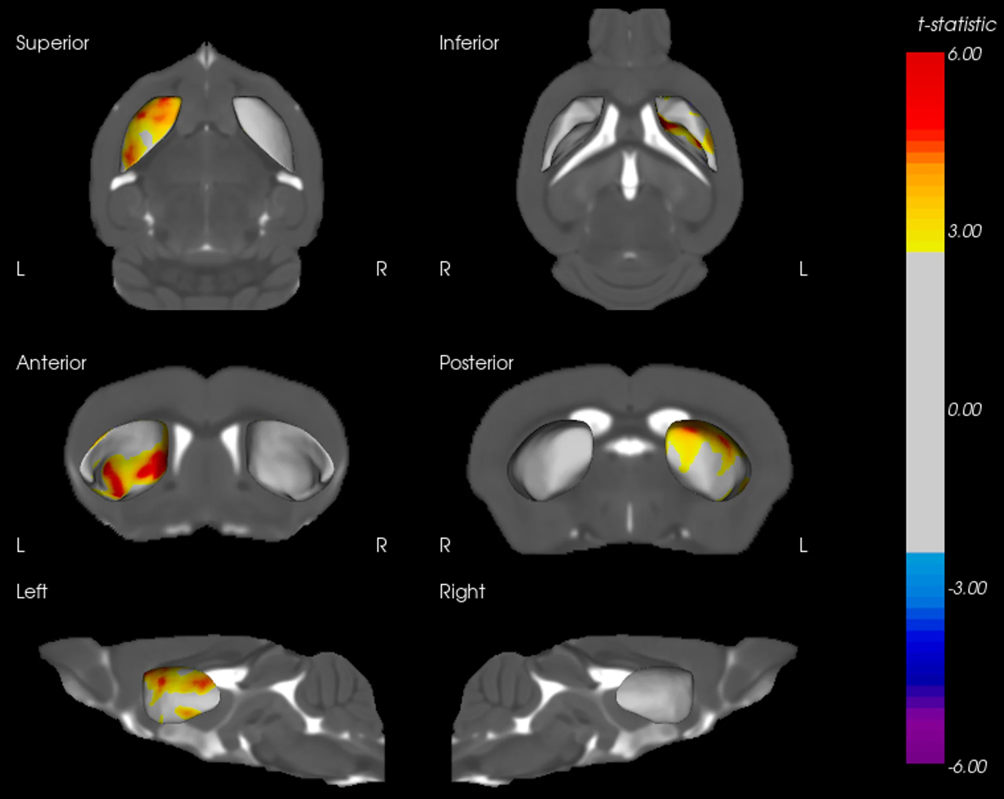 纹状体变形与 TH 密度之间的相关性