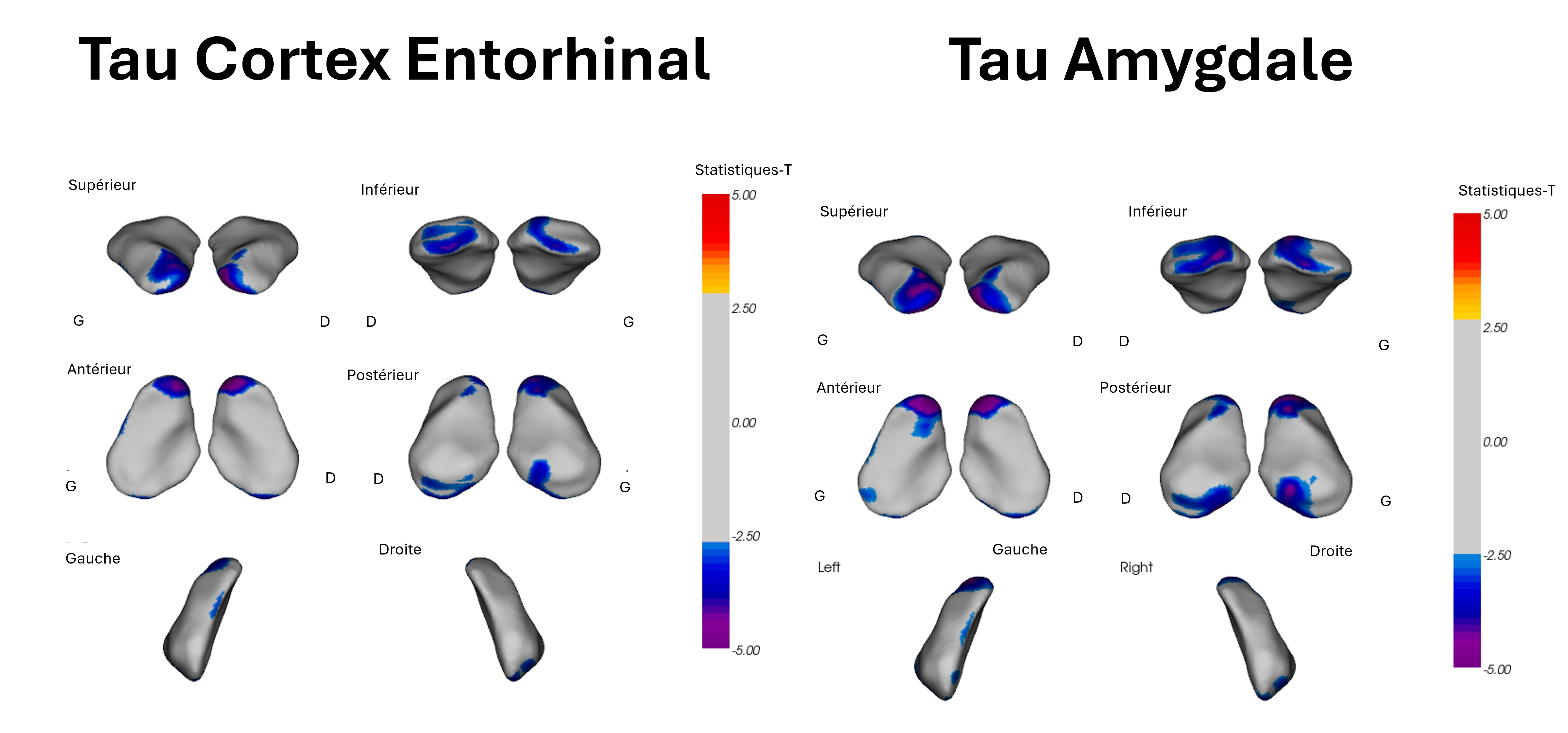 Association entre la déformation de la surface de l'amygdale et le SUVR de la protéine Tau mesuré par TEP