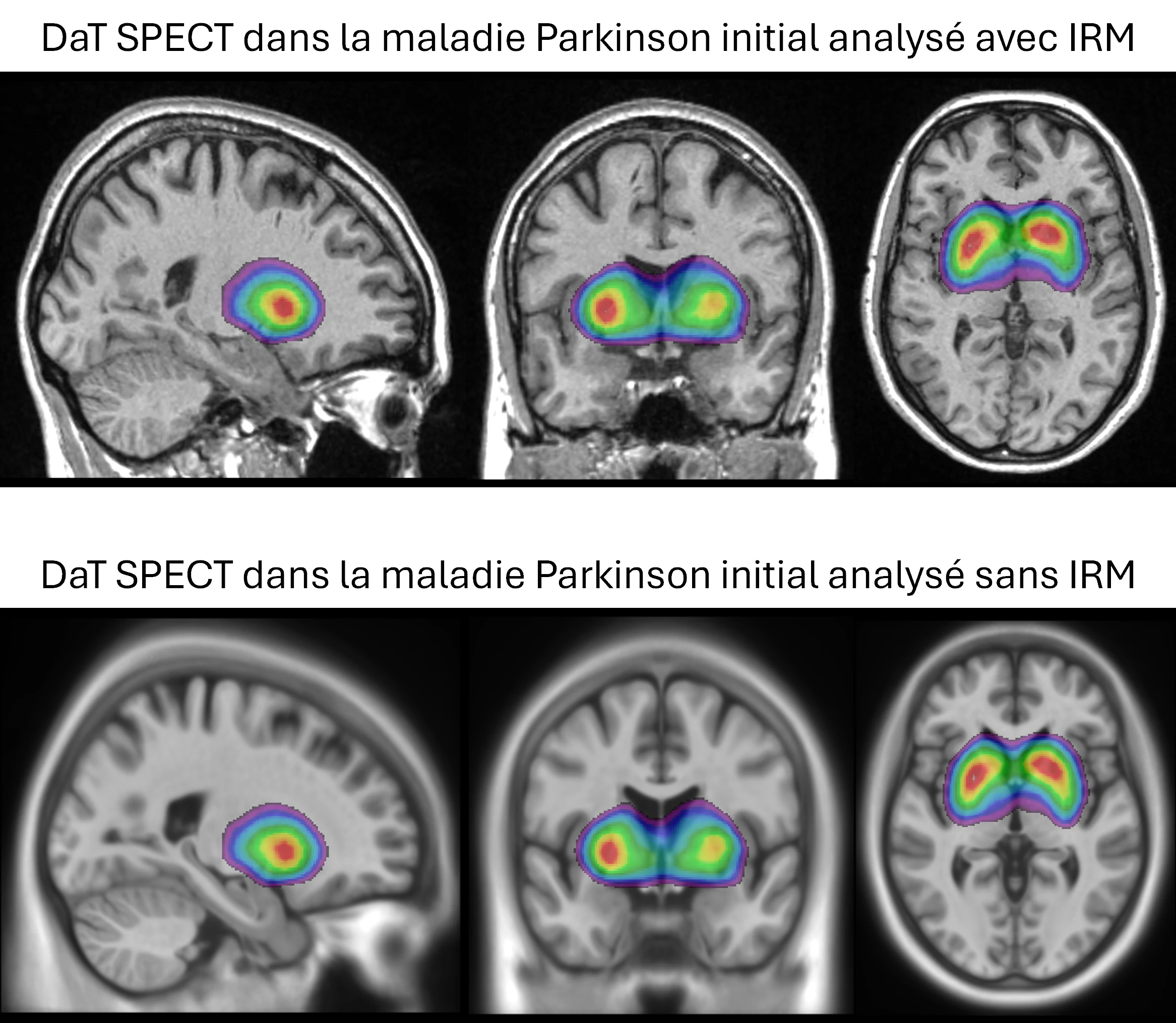 Exemple d'images DAT SPECT