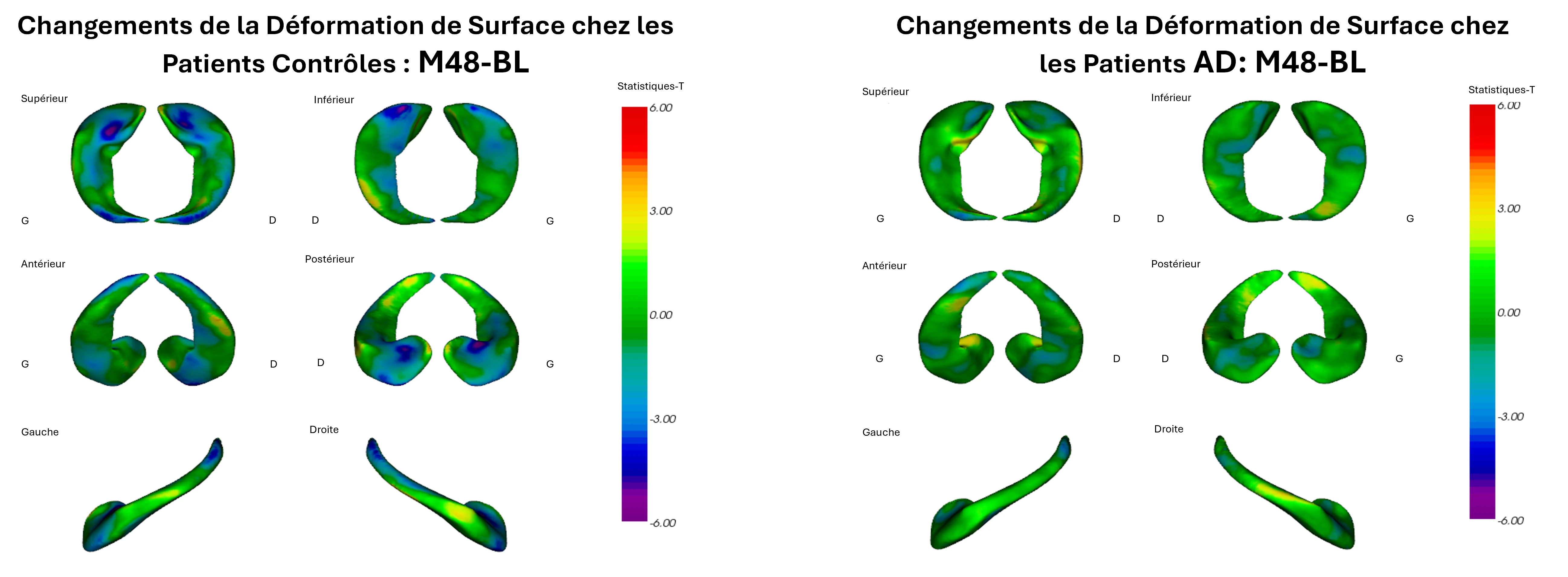 Analyse longitudinale de la déformation de l'hippocampe 