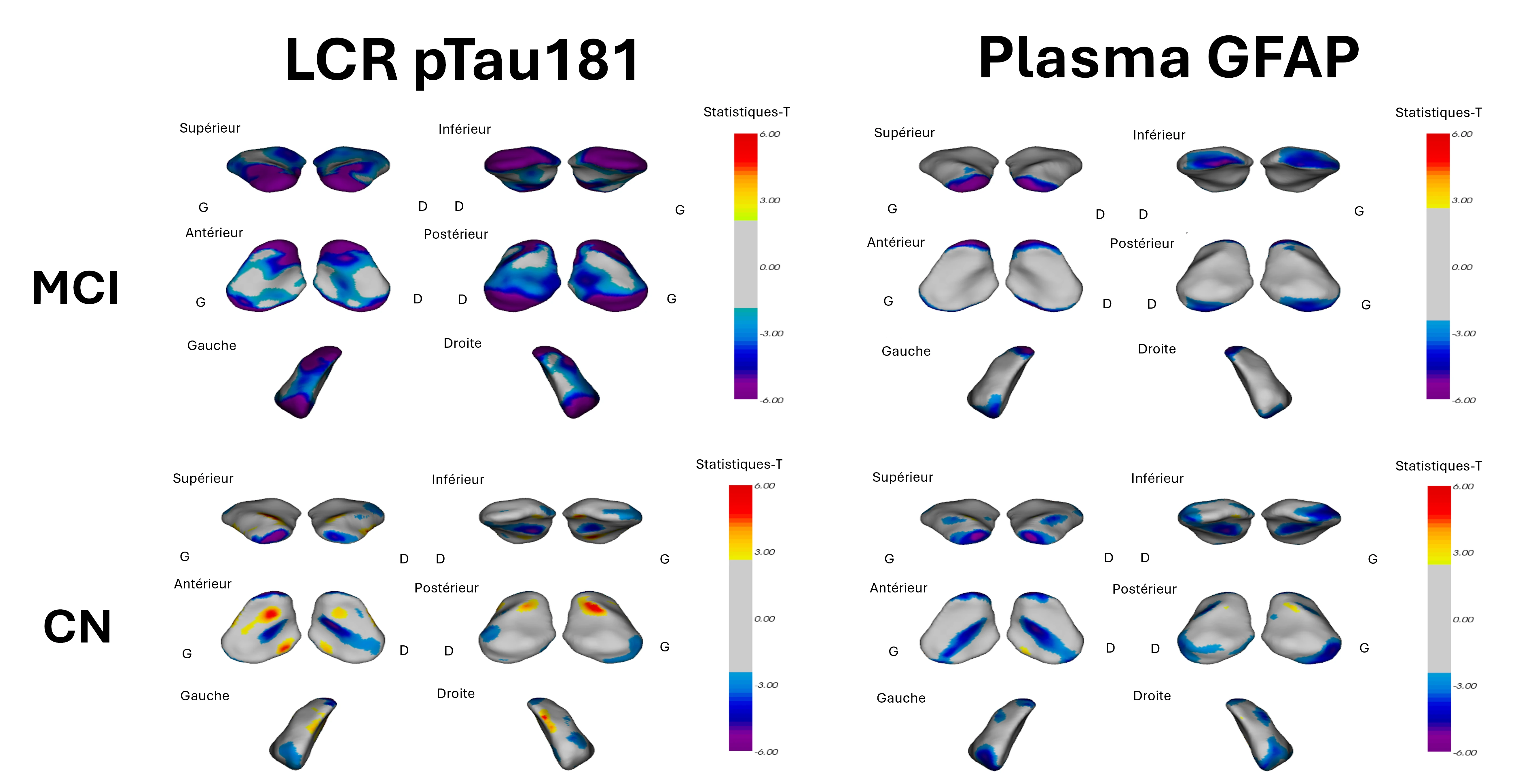 Corrélation entre la déformation de la surface de l'amygdale et les taux de ptau 181 dans le LCR et de GAFP dans le plasma