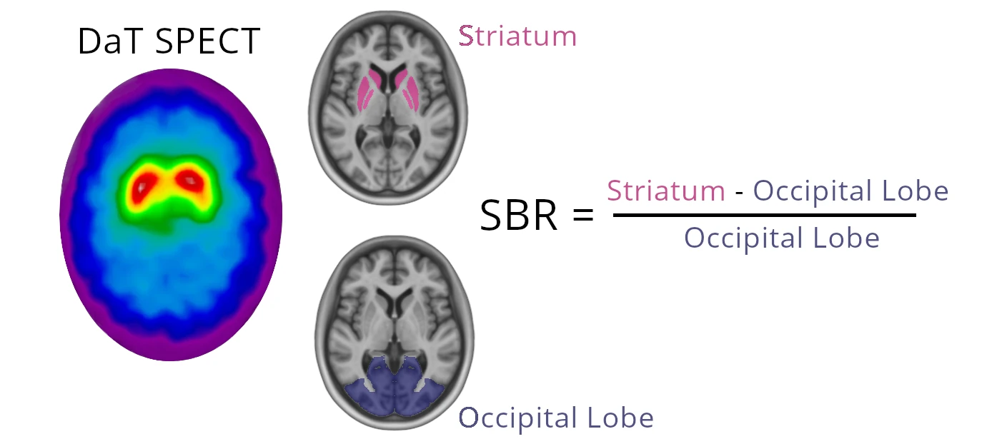 DAT SPECT SBR Infographic